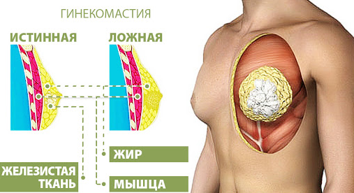 Лечение гинекомастии 