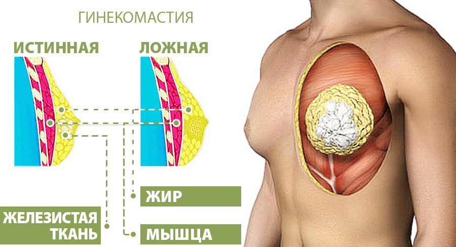 Симптомы гинекомастии