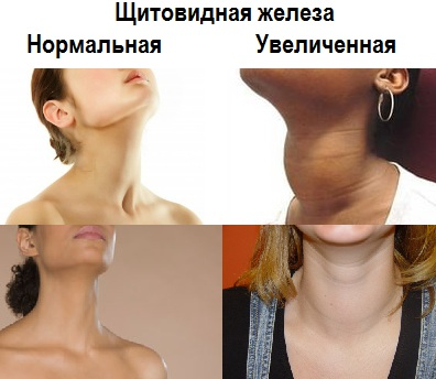 Что значит объем щитовидной железы меньше нормы у женщин. Смотреть фото Что значит объем щитовидной железы меньше нормы у женщин. Смотреть картинку Что значит объем щитовидной железы меньше нормы у женщин. Картинка про Что значит объем щитовидной железы меньше нормы у женщин. Фото Что значит объем щитовидной железы меньше нормы у женщин