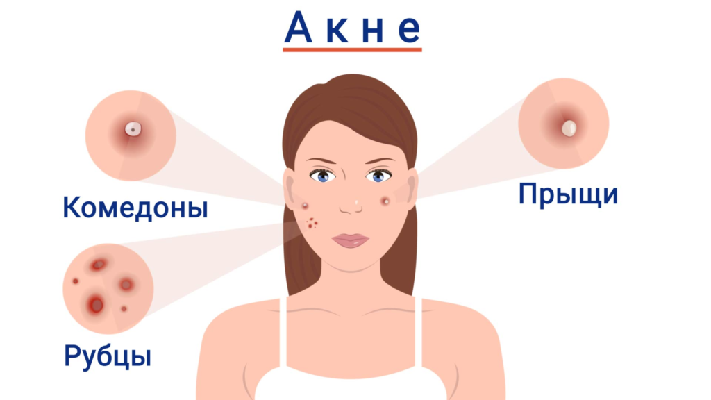 Прыщи на щеках